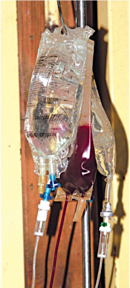 Аппарат для переливания крови